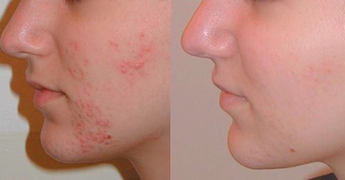Benzoyl Peroxide Wash - Before And After
