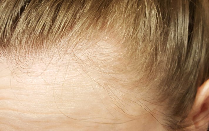 tiny hairs regrowing around my hairline - this was two/three weeks in 